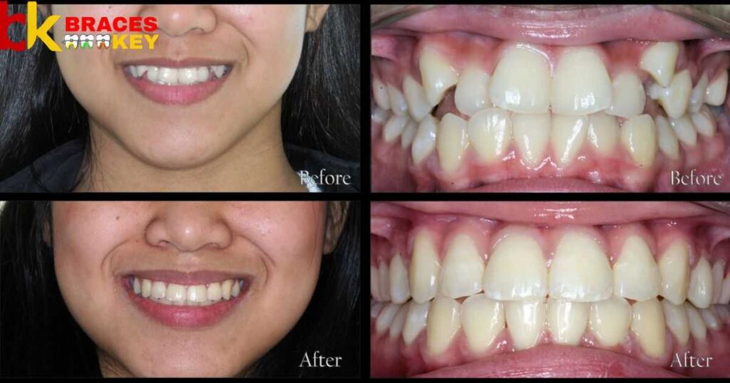 Effect of Braces on Adjacent and Opposing Teeth