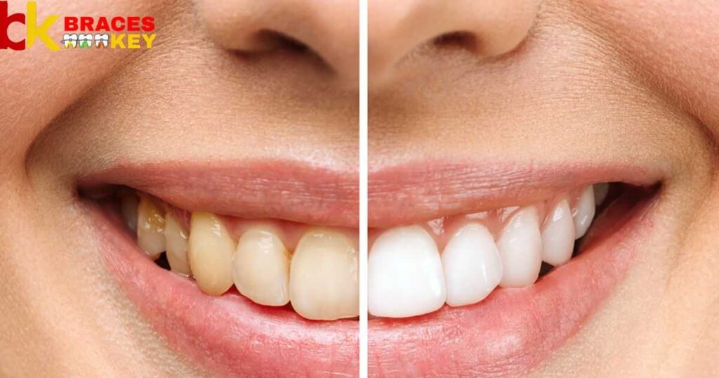 Whitening After Braces Removal