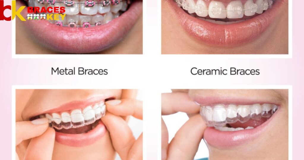 Types of Braces