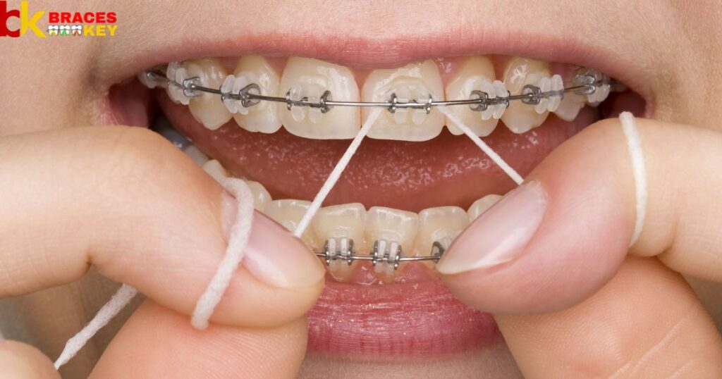 Dealing with Cavities While Wearing Braces