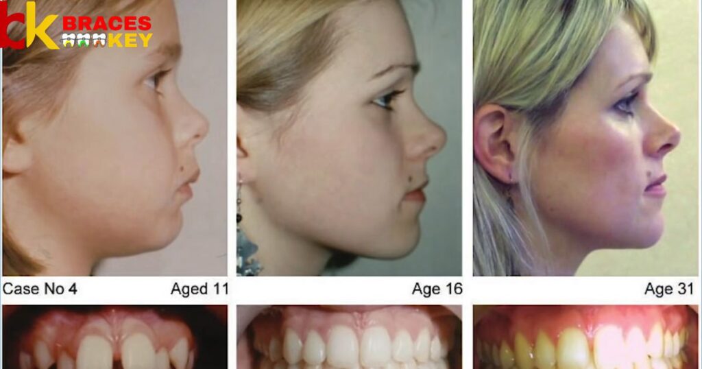 The Effects of Age On Length of Braces Treatment