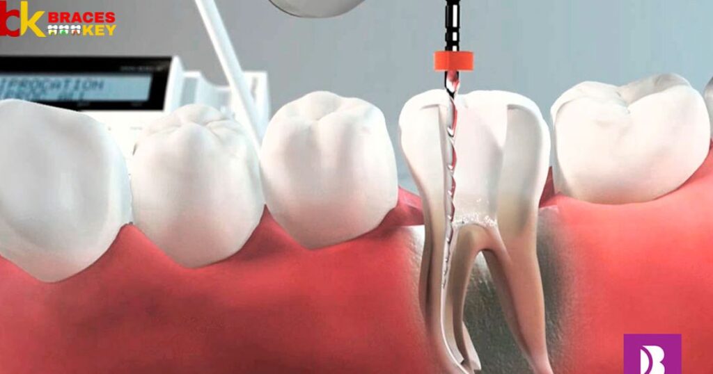 Root canal a closer look