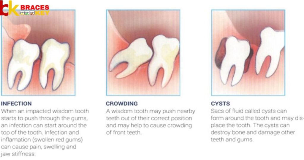 What are impacted wisdom teeth