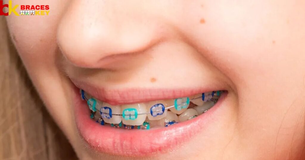 What is the best color for your braces