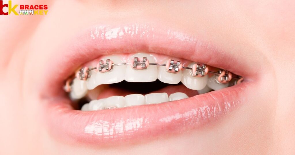White rubber bands on braces