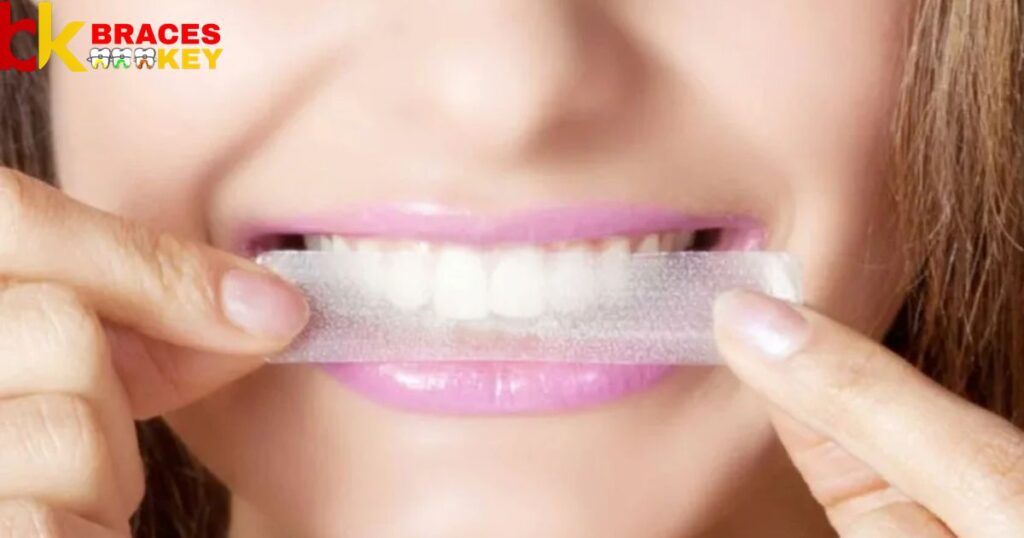 Why Using Whitening Strips with Braces Is Problematic