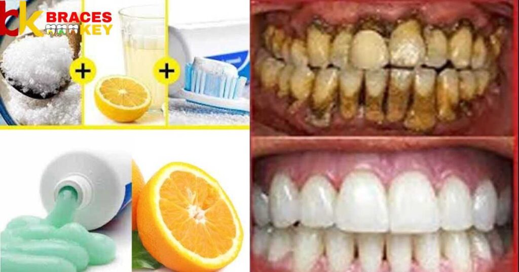 Home Remedies for Overnight Teeth Whitening with Braces