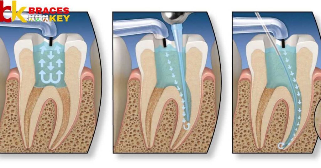 Root Canals and Braces