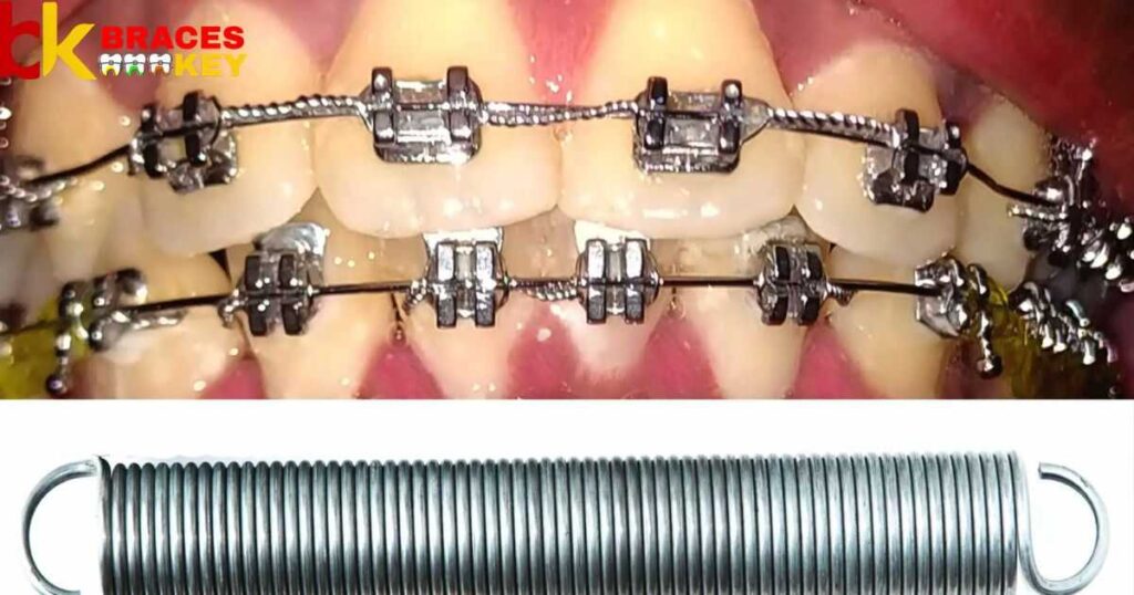 Wires Come Off Braces