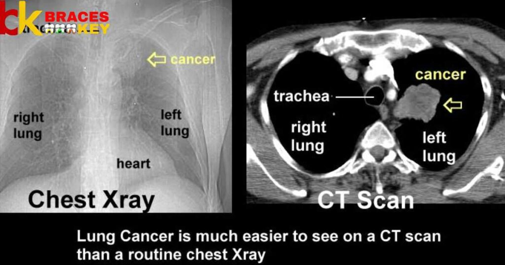 Get A CT Scan With Metal In Your Body