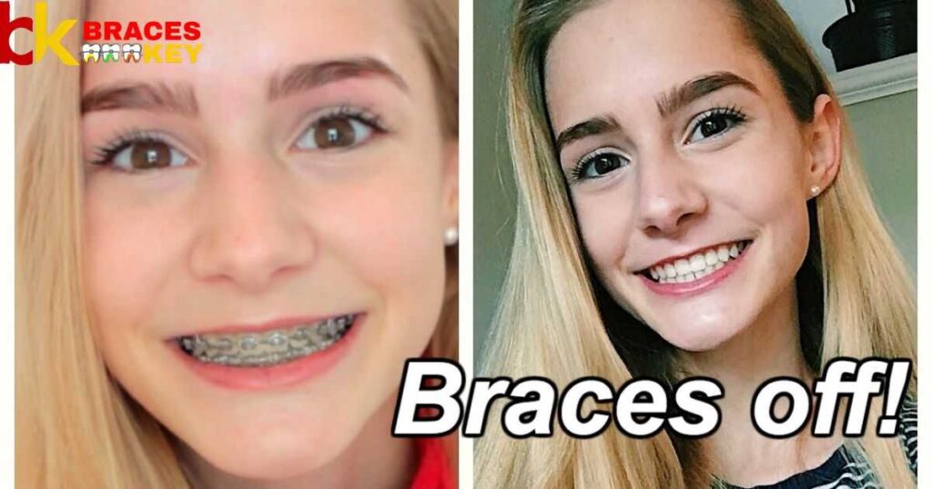 Get Braces Off Without Insurance