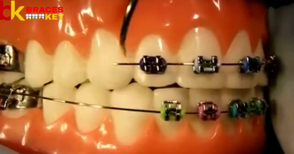 Bent Wire On Your Braces