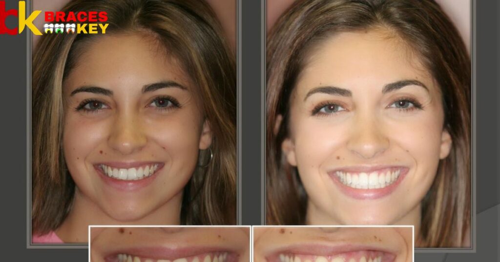Braces Invisalign Before And Afters