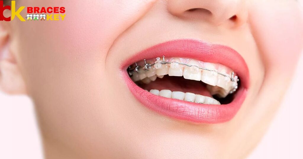 Clear Braces That Turned Yellow