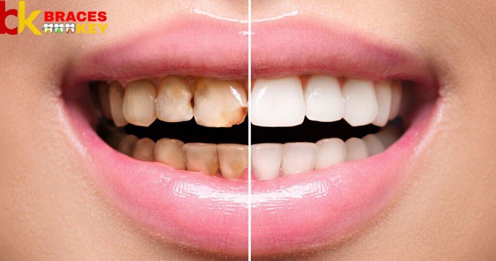 Common Are White Spots After Braces
