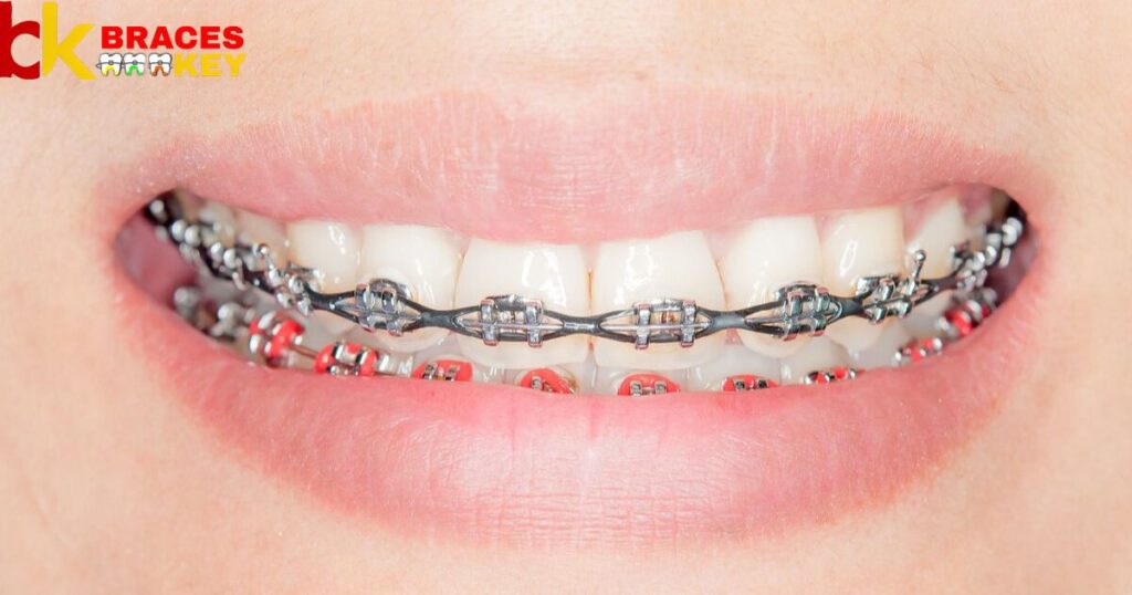 Braces Covered By Insurance