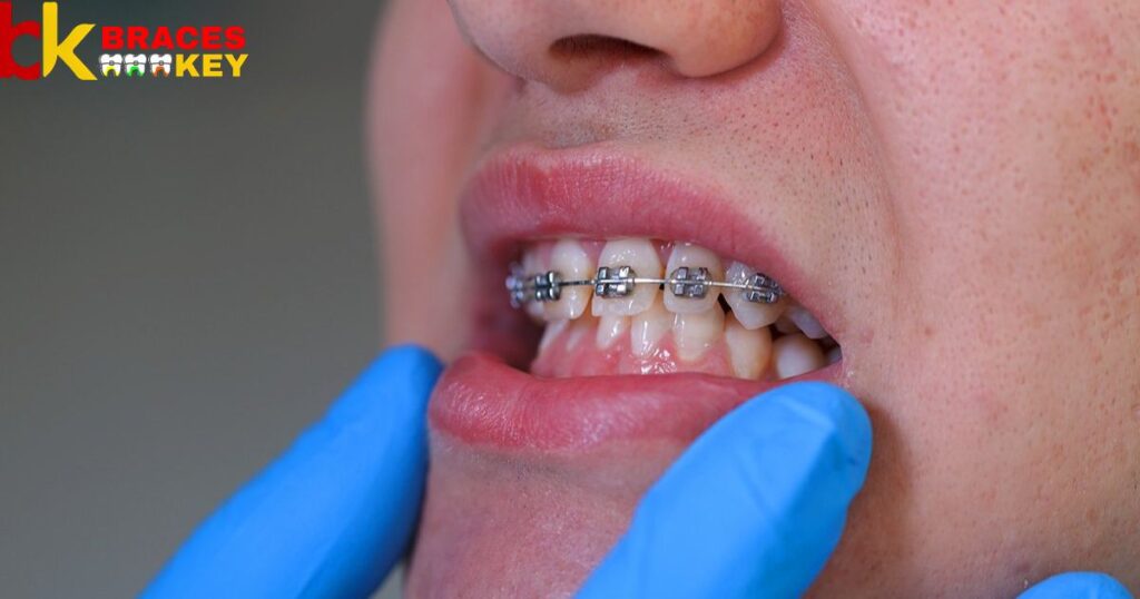 Get Braces If You Have Receding Gums