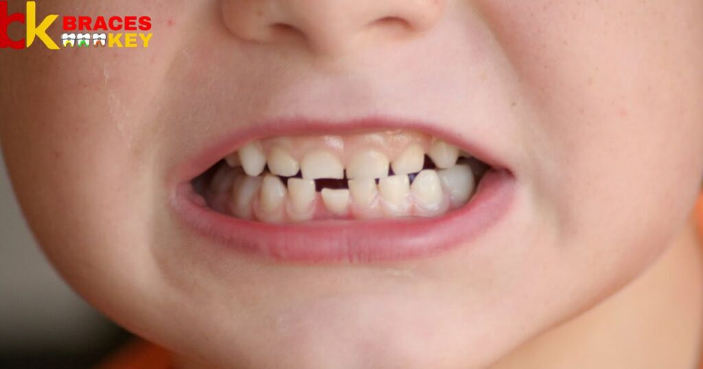 Get Braces With Baby Loose Teeth