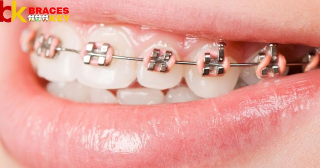 Aetna Orthodontist Coverage