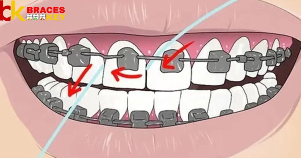 If You Don't Floss Your Teeth With Braces So The Result