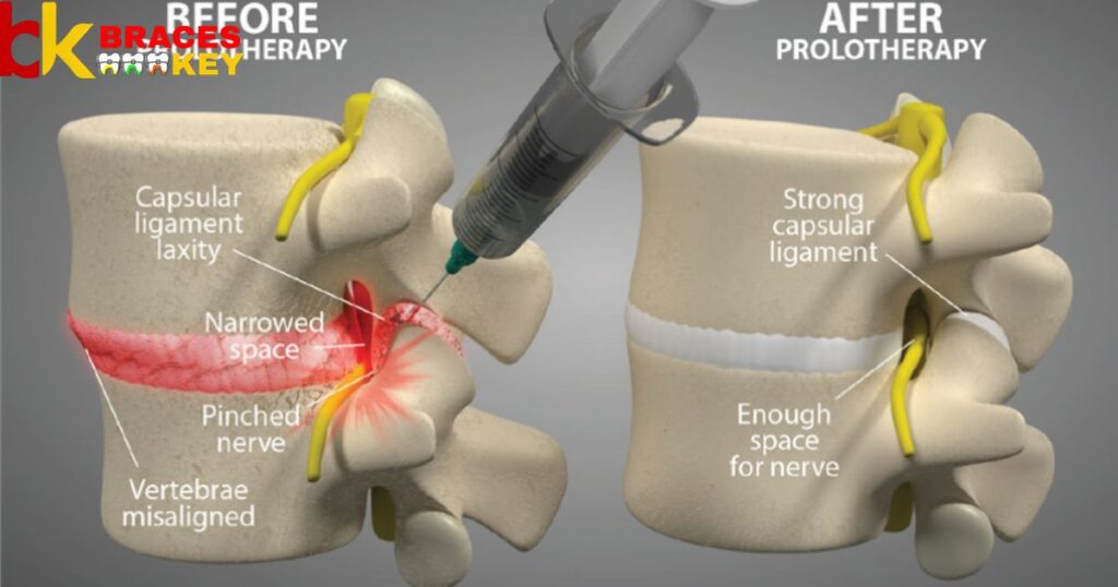 Lumbar Spinal Stenosis Treatment