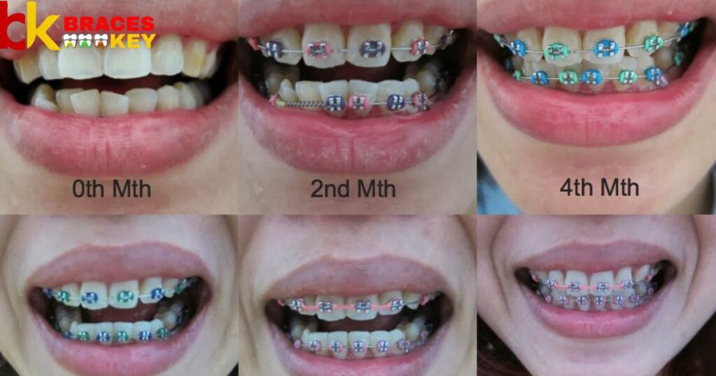 Often I Can Change The Colors Of The Braces