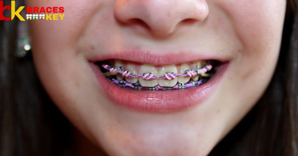 Pink A Bad Color For Braces