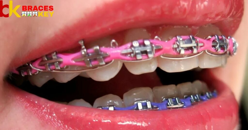 Pink Braces Make Your Teeth Look Yellow