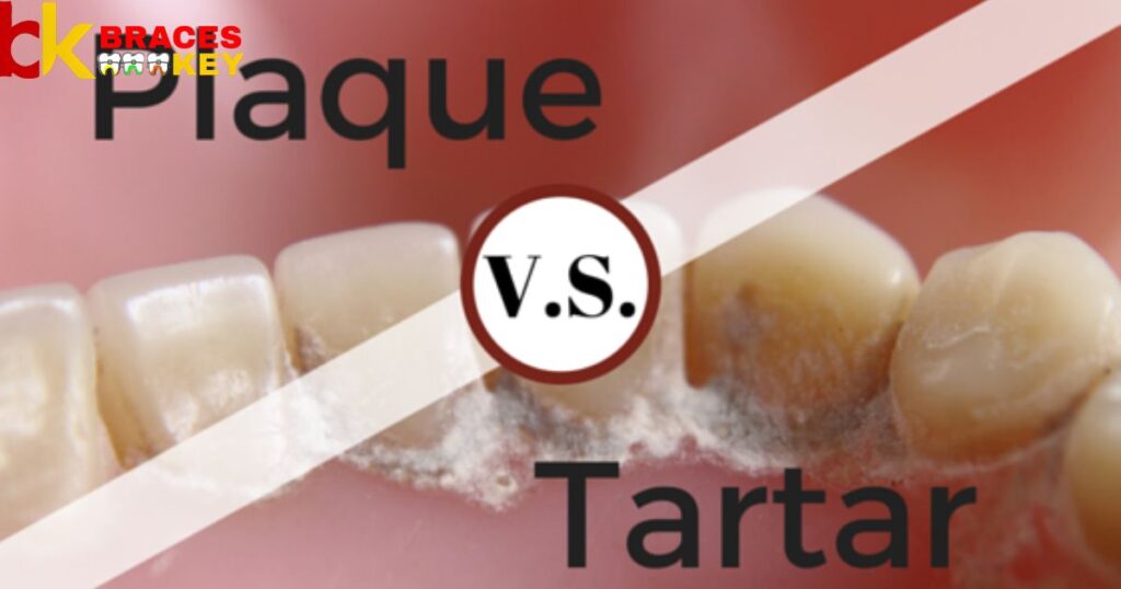 Plaque vs Tartar