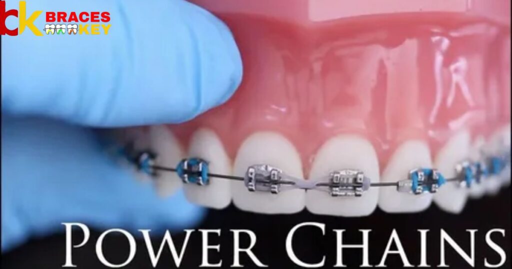 Power Chains The Last Stage Of Braces Rubber Bands