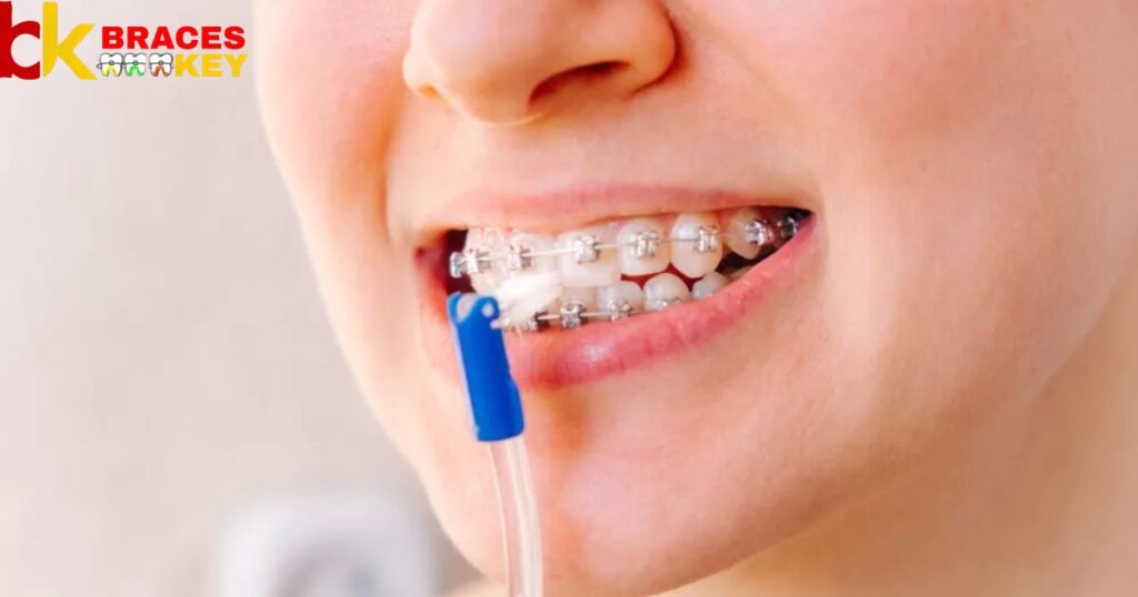 Preventing Dental Issues When Wearing Braces