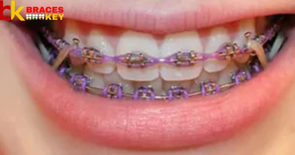 Rubber Band With Braces