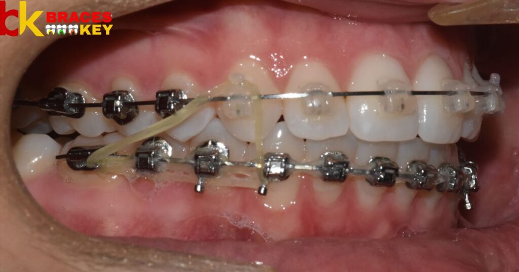 Stages Of Braces Rubber Bands