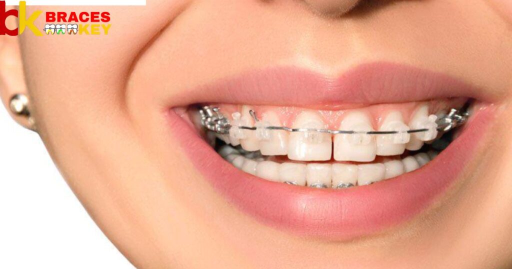 Stains Of Braces Bands