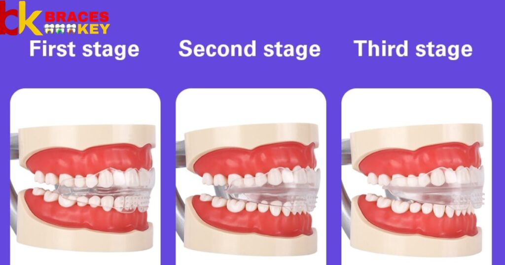 The First Phase Of Braces