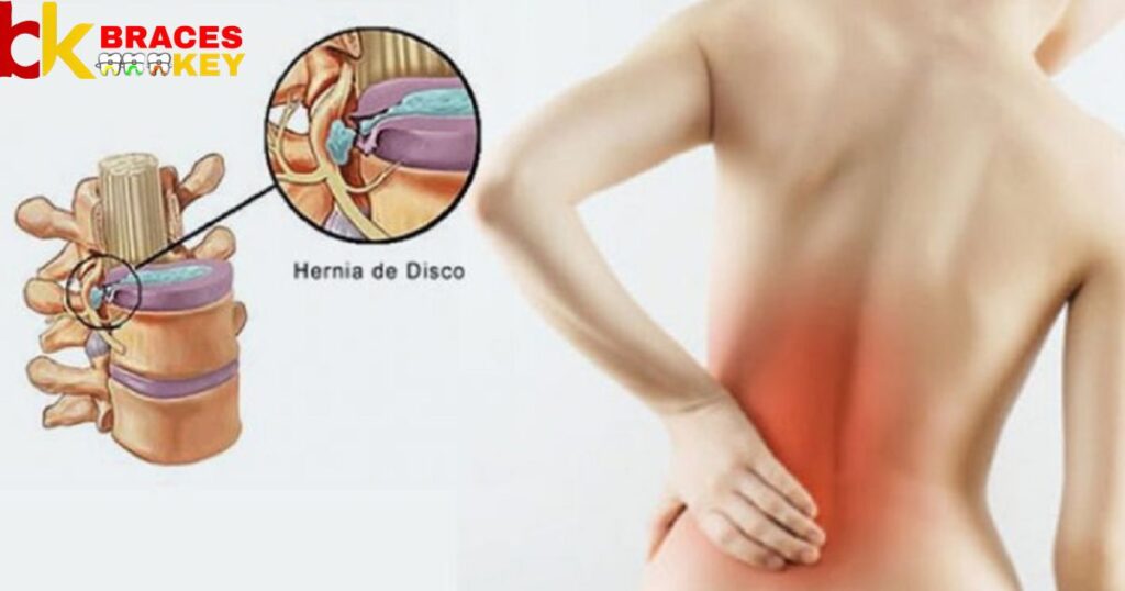 The Impact of Herniated Discs on Daily Life