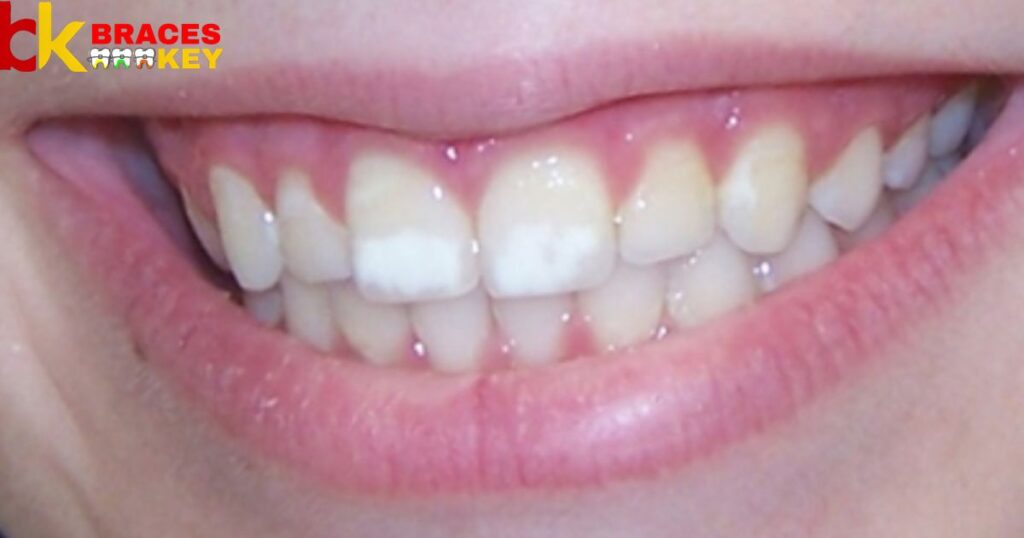 White Spots On Teeth After Braces