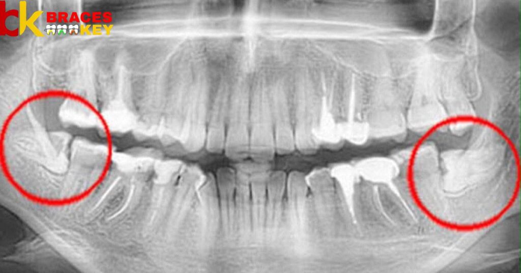 Wisdom Teeth & Alignment What You Need to Know