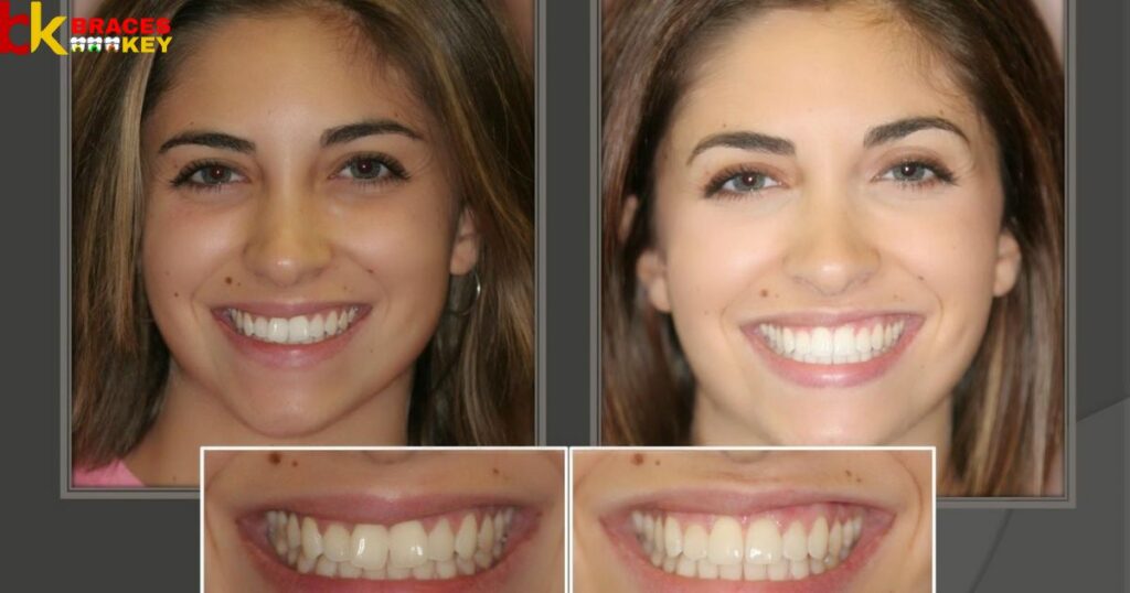 Before And After Of Braces