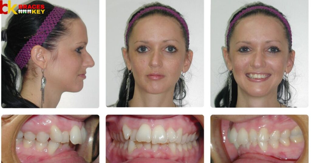 Get Rid Of An Overbite Without Braces At Home