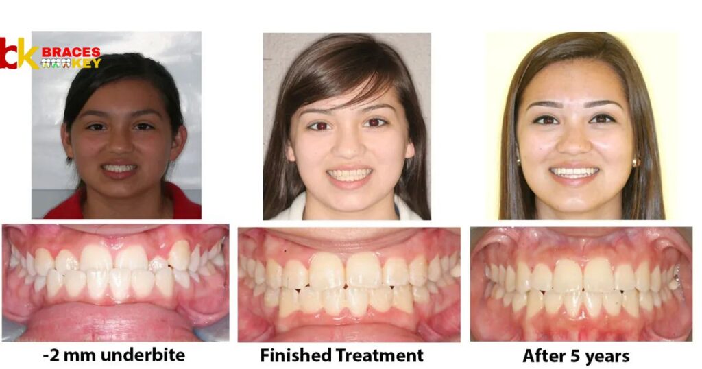 Overview Of Fix An Overbite Without Braces