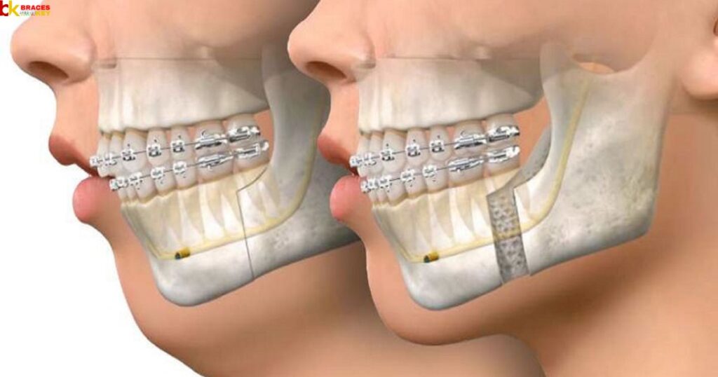The Science Behind Jaw Expansion With Braces
