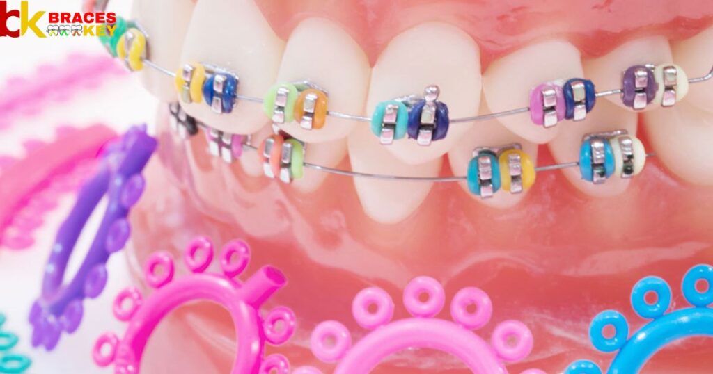 Tips On Choosing The Right Color Braces For Quiz