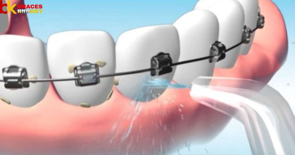 Water Flosser For Braces Reddit