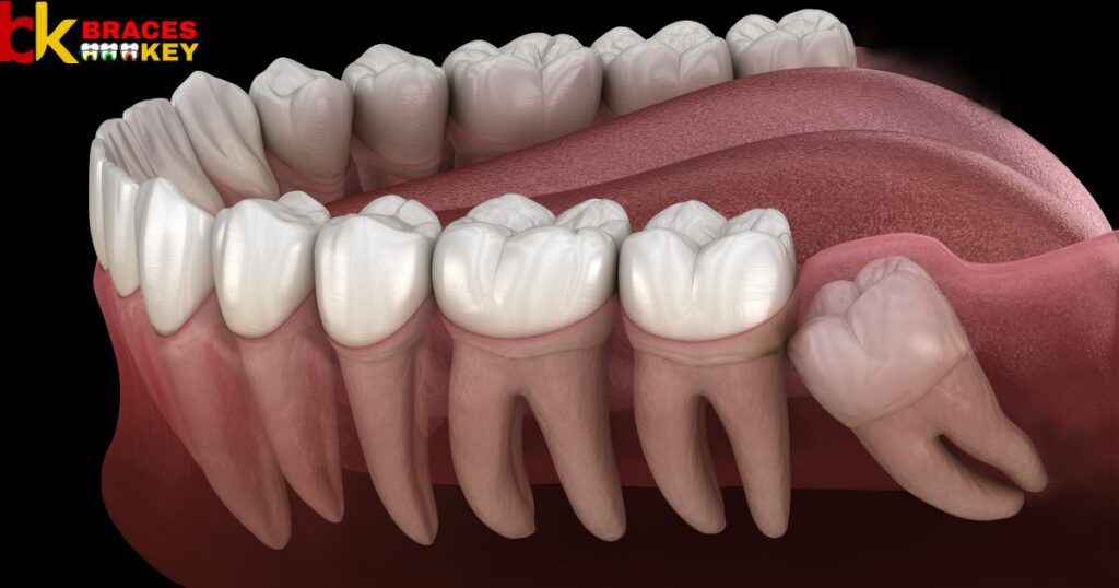 Anchoring Tooth Movements