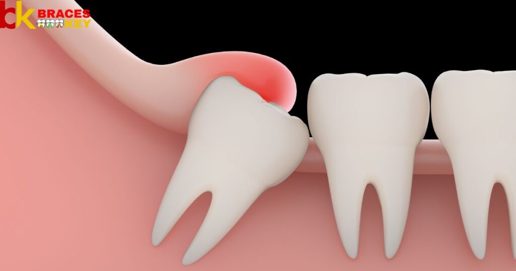 Are Molar Bands Painful