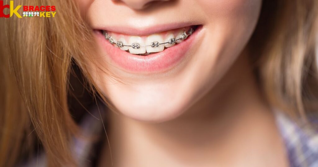Braces Wire Thickness