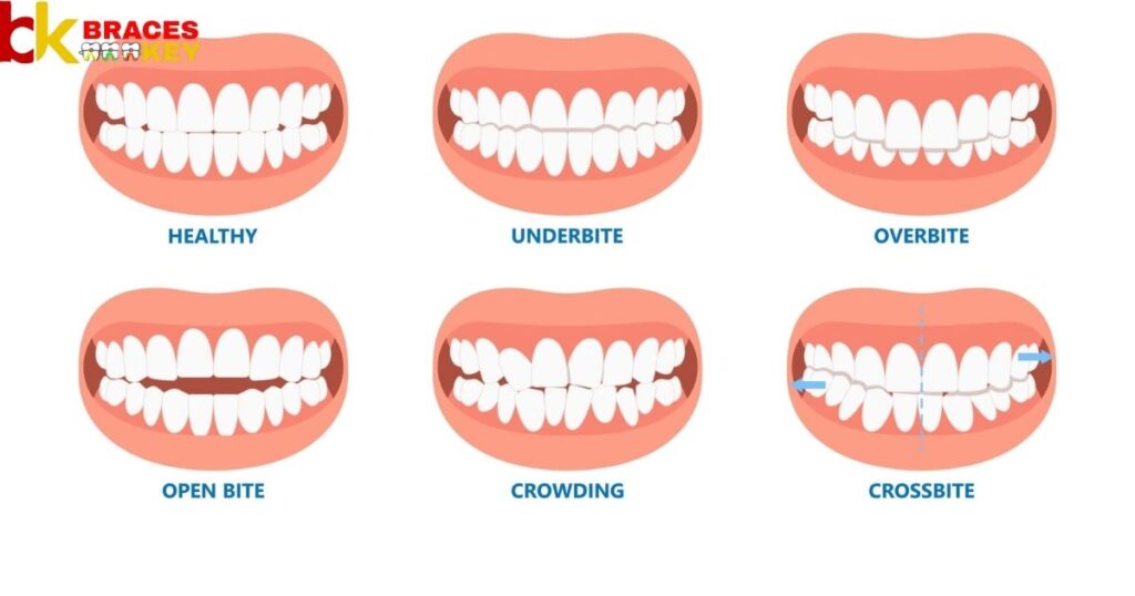 Can An Overbite Or Buck Teeth Be Corrected With Braces