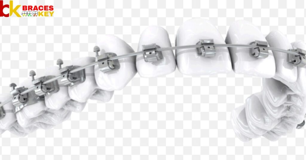 Different Braces Wires Stages