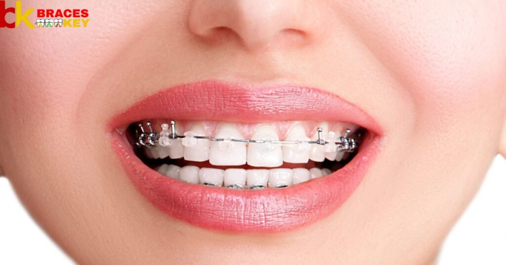 Different Types Of Archwires For Braces